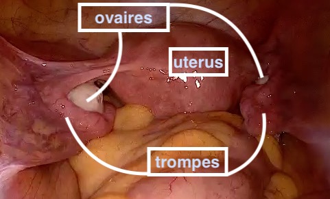 chirurgie trompes-ovaires - drguihard